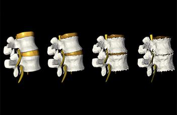 Дегенерация межпозвоночного диска