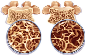 Остеопороз позвоночника, симптомы и лечение
